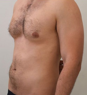 Pan Krzysztof lat 34 - liposukcja brzucha